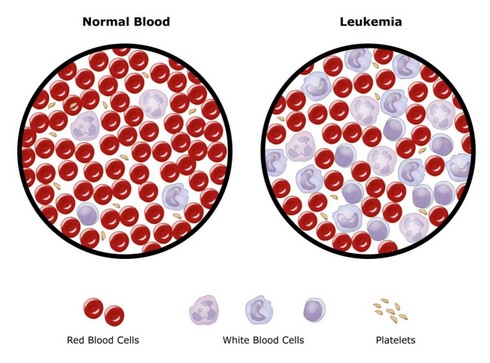 Leukemia simptom Simptomi leukemije